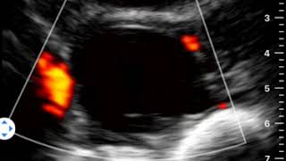 Ovarian Cyst 2 | Clinical Image