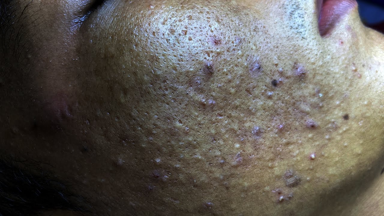Blackhead Treatment Part 2| Mụn Đầu Đen Siêu Hot Phần 2 - SacDepSpa#105