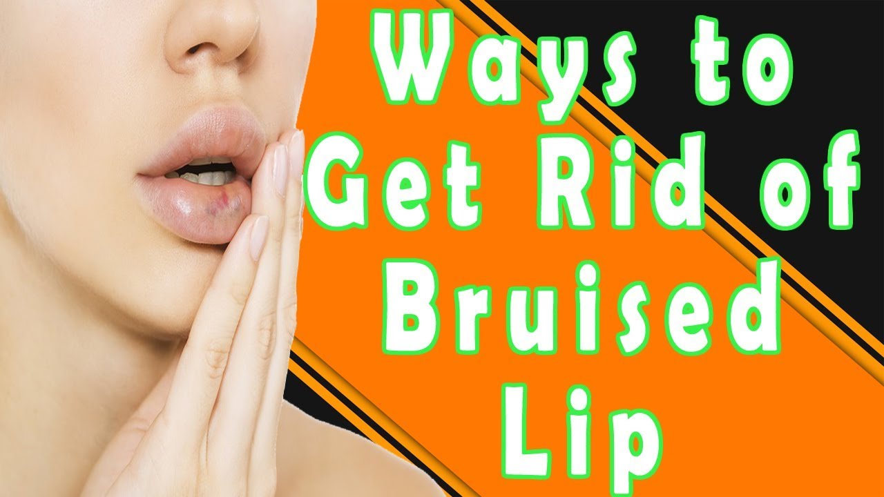 How To Get Rid Of A Bruised Lip | Ways To Get Rid Of A Bruised Lip (Swollen Lips)