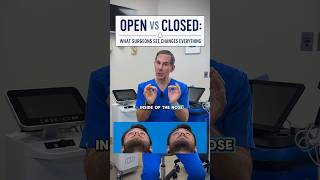 OPEN vs CLOSED rhinoplasty isn’t about which one is “better.” It’s about which one is RIGHT for you.