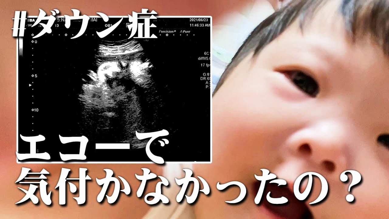 ダウン症 みゆちゃんを妊娠していた時のエコー写真大公開 エコー写真 Youtube