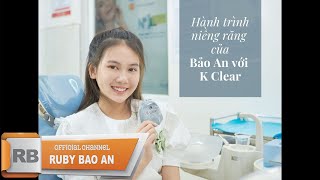 Hành trình niềng răng của Bảo An với K Clear