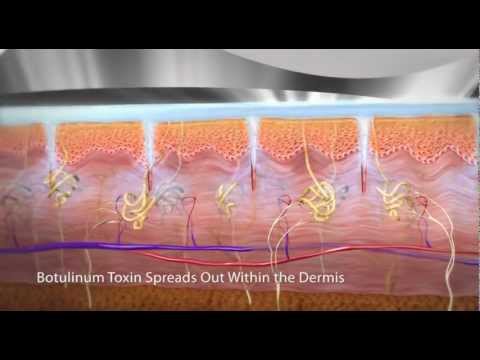 Treating Hyperhidrosis of the Palm - YouTube