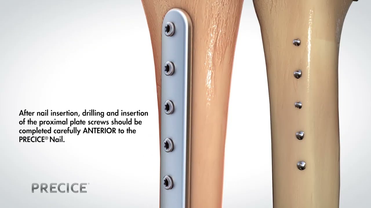 Plate Assisted Bone Segment Transport | Globus Medical
