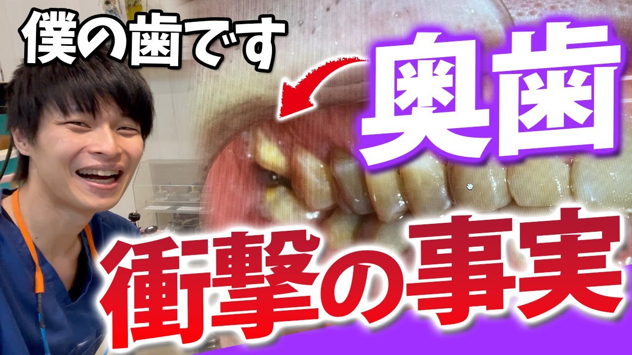 【抜歯 親知らず 虫歯 】直接診断でイケメン歯科医師のお口に問題を多数発見！
