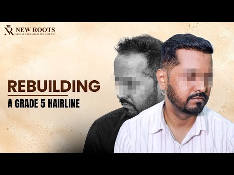 5500 Grafts, 9 Months Later! 😍 | Hair Transplant in Pune | Cost and Best Results in Pune | New Roots