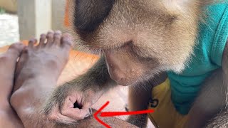 Big Remove For Me! Tin Monkey Try To Clean And Grooming My Fungal Infection