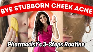 (How To Fix) CHEEK ACNE That Won't Go Away in 3 Steps: Meaning, Causes, Treatment + Home Remedies