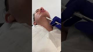 Aqualyx marking chin