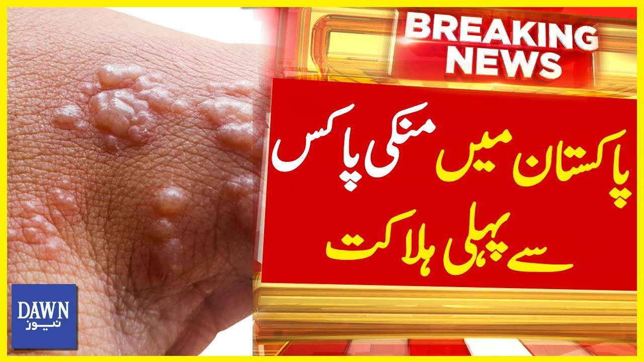 First Death From Monkeypox Confirmed In Pakistan | Breaking News | Dawn ...