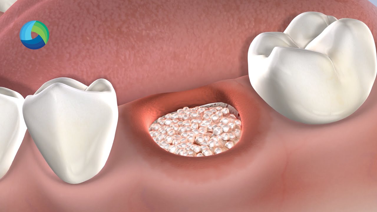 Socket Preservation in New Brunswick NJ: Dr. Richard Stern | Oral Surgery Group