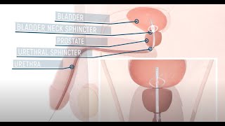 Flat Medical UroAid-IV urinary catheter - 3D medical animation by Amerra Medical 48,819 views 3 years ago 1 minute, 19 seconds