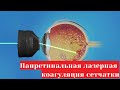 Панретинальная лазерная коагуляция сетчатки глаза 💥👀 - как проводится и для чего нужна