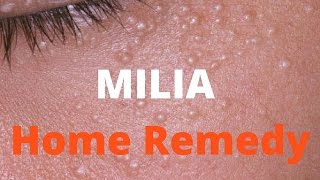 Milia treatment