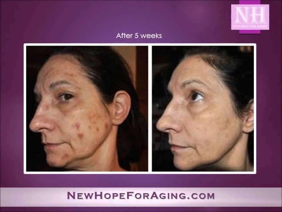 Amazing Before and After Photos of Anti Aging with Adult Stem Cells