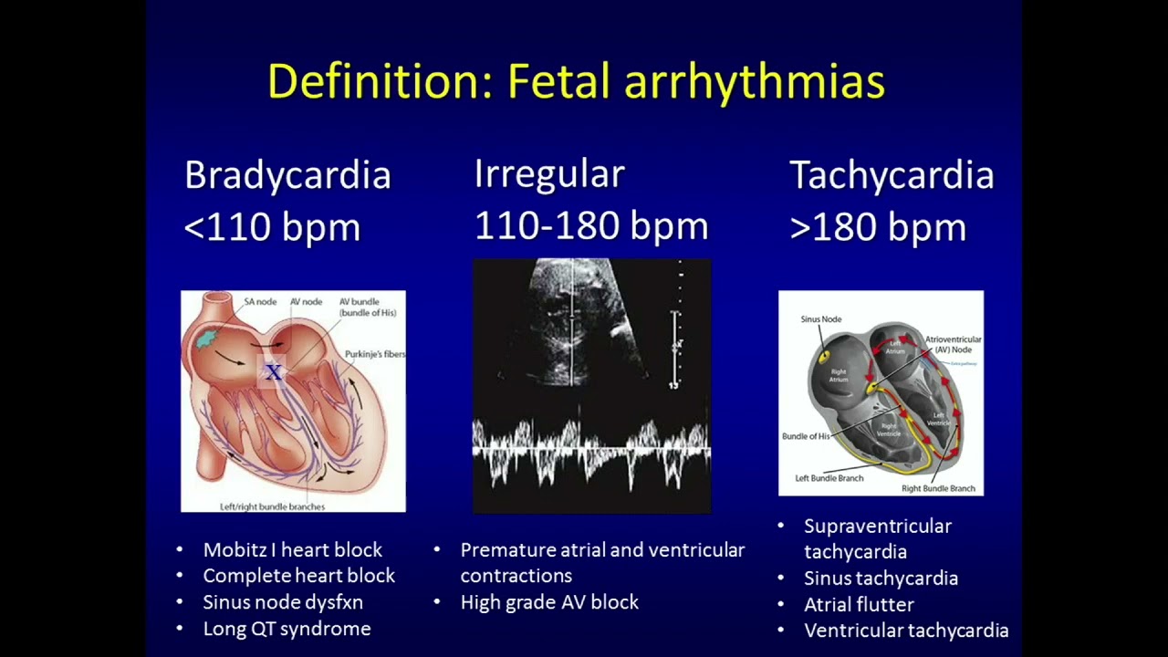 What Causes Arrhythmia In Pregnancy