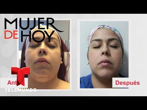 Dile adiós a la papada para siempre | Telemundo Mujer | Telemundo