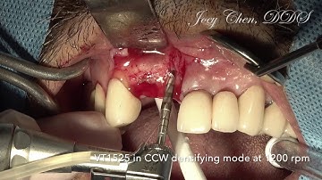 Socket shield technique with Osseodensification
