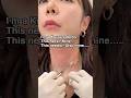 Neck Wrinkle Treatment in Korea | Botox and Filler by a Seoul Doctor