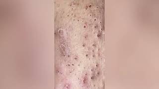 Full blackheads ВЫДАВЛИВАНИЕ ОГРОМНЫХ УГРЕЙ ЧЕРНЫЕ ТОЧКИ УГРИ ПРЫЩИ ПОДБОРКА Pimple Popping