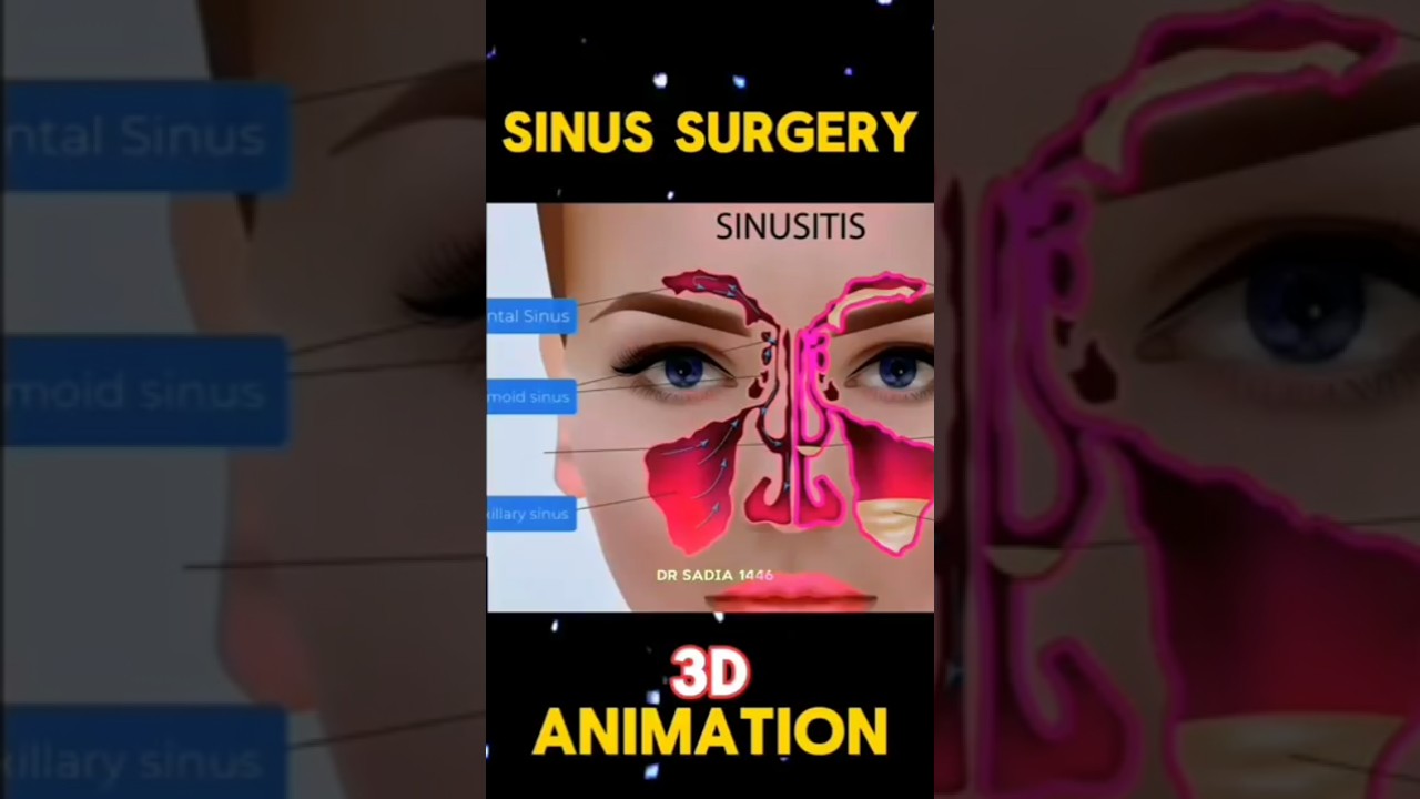 ENT surgery animation|साइनस सर्जरी एनीमेशन|Sinus surgery animation 