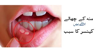 Why Mouth ulcers are caused and what is their treatment? | Mouth Ulcers | Mouth Problems Information