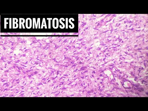 Video: Fibroma - årsaker Og Symptomer På Fibroma, Diagnose, Behandling Og Forebygging