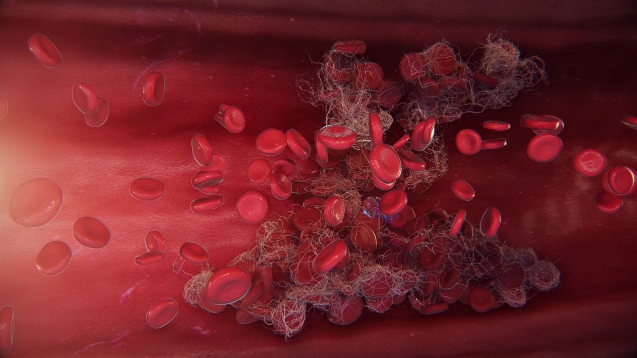 Коронавирус тромбы. Микроваскулярный тромбоз. Растворение сгустка крови.