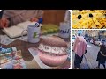 Vlog dentiste pour vrification de lappareil dentaire petite pizza et bouteille deau coranis