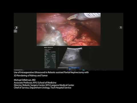 bk-medical-robotic-assisted-partial-nephrectomy-with-3d-rendering-by-michael-stifelman,-md