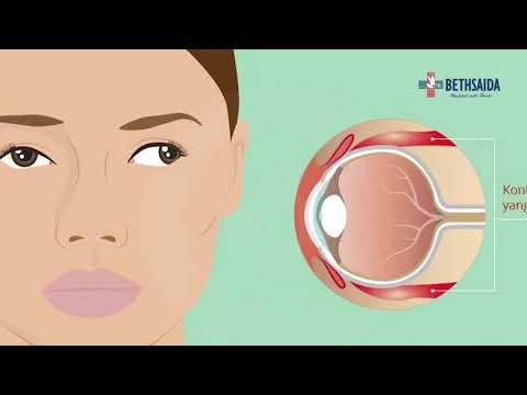 Video: Apakah mata juling memengaruhi penglihatan?