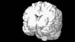MRIcroGL - 3D Brain Visualization