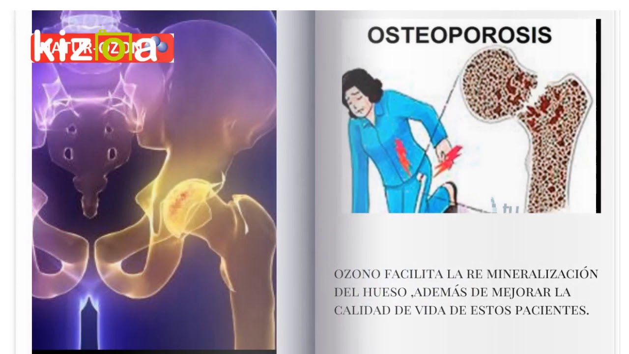 OSTEOPOROSIS 