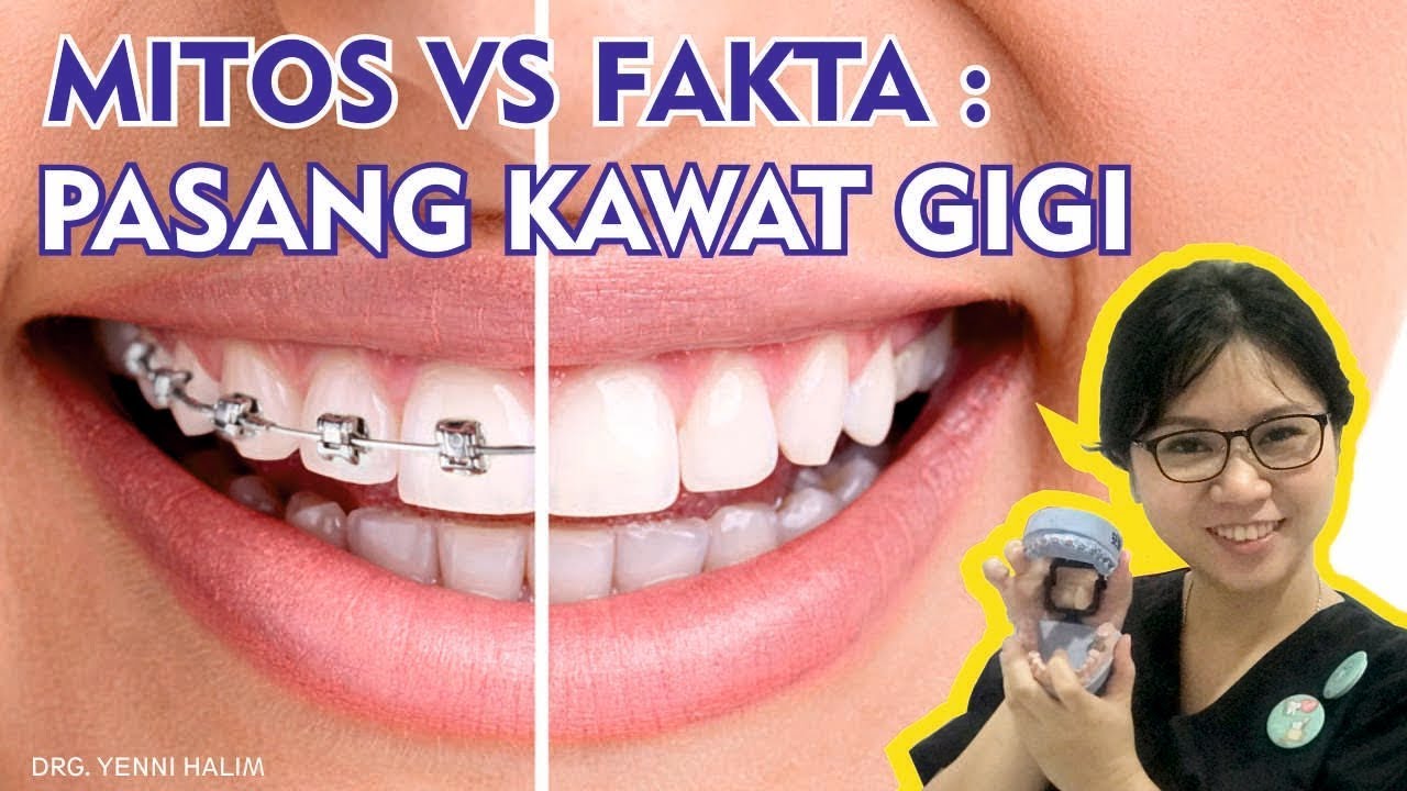 MITOS VS FAKTA: PASANG KAWAT GIGI