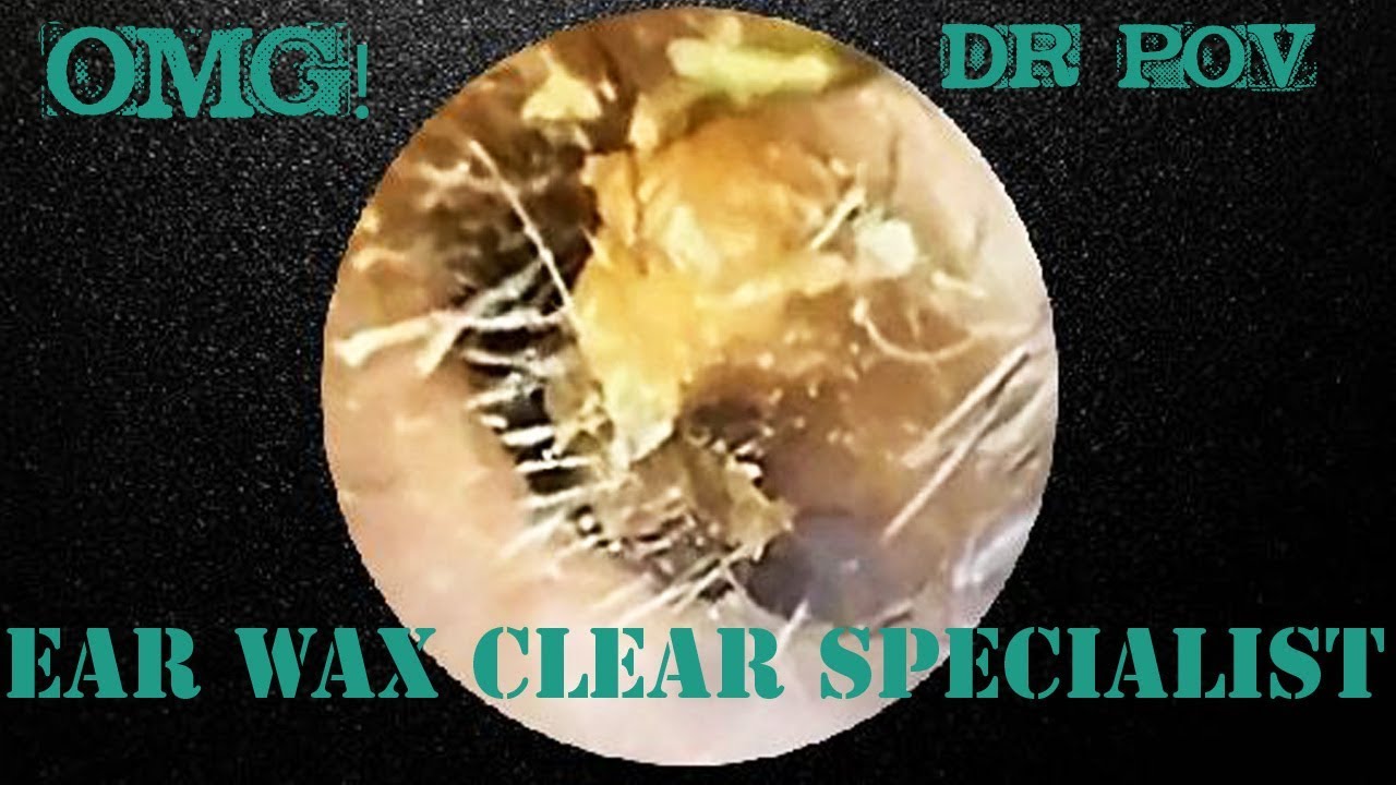 Ear clean: Cholesteatoma #23, Ear cleaning! Ear wax pressed with a cotton swab, safe ear