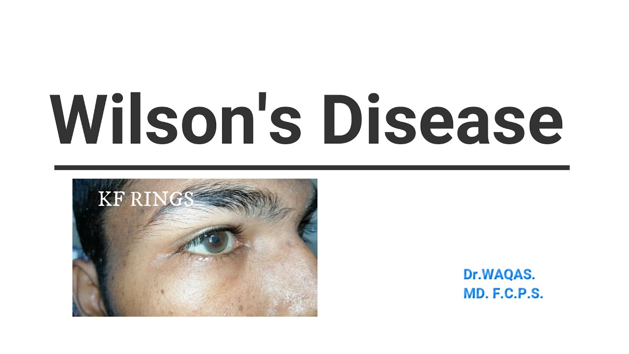 WILSON DISEASE.(Examination Skills) YouTube