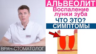 Альвеолит - воспаление лунки зуба после удаления зуба, как часто встречается, симптомы