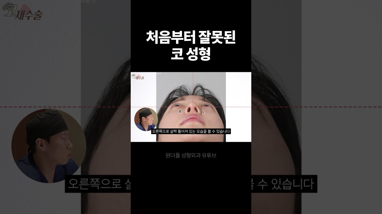 [Вондерфүл Гоо сайхны эмнэлэг] Эхнээсээ буруу хийгдсэн хамрын мэс засал