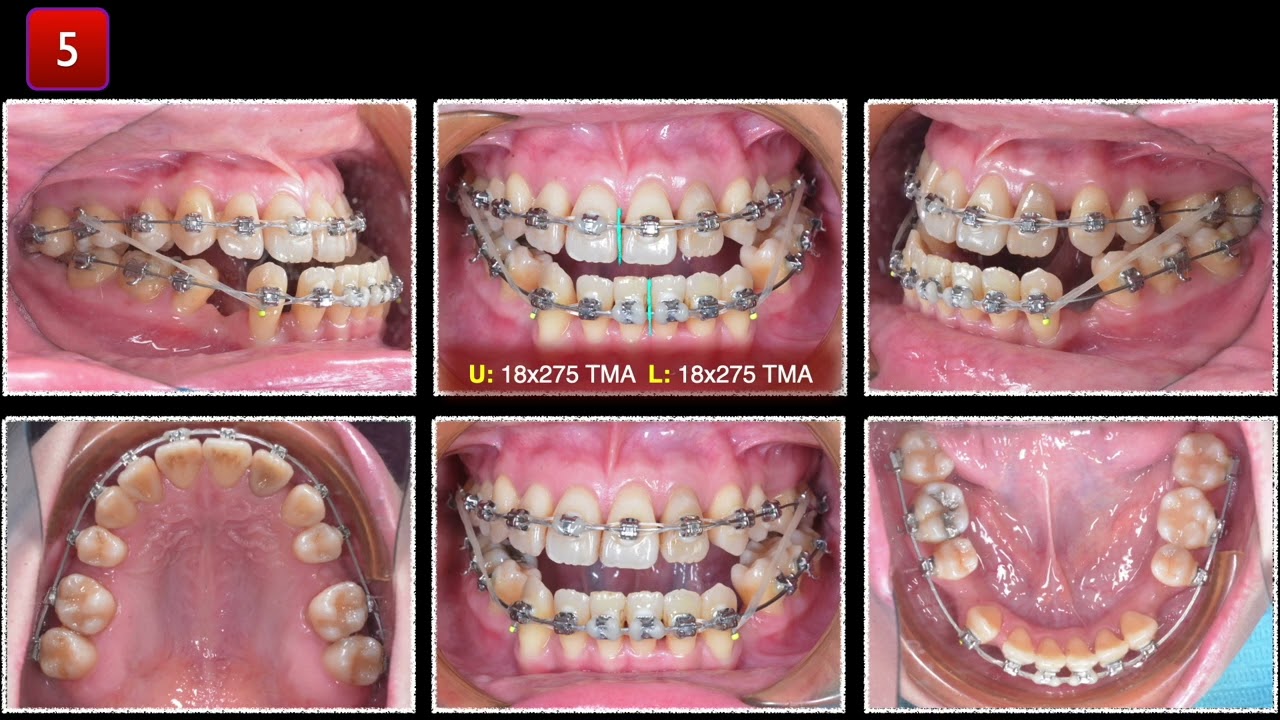 Class III Asymmetry ｜【Chris Chang Ortho】CC859 - YouTube