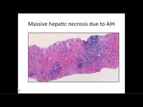 Overview of Liver Pathology