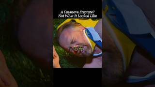 A Casanova Fracture? Not What It Looked Like.