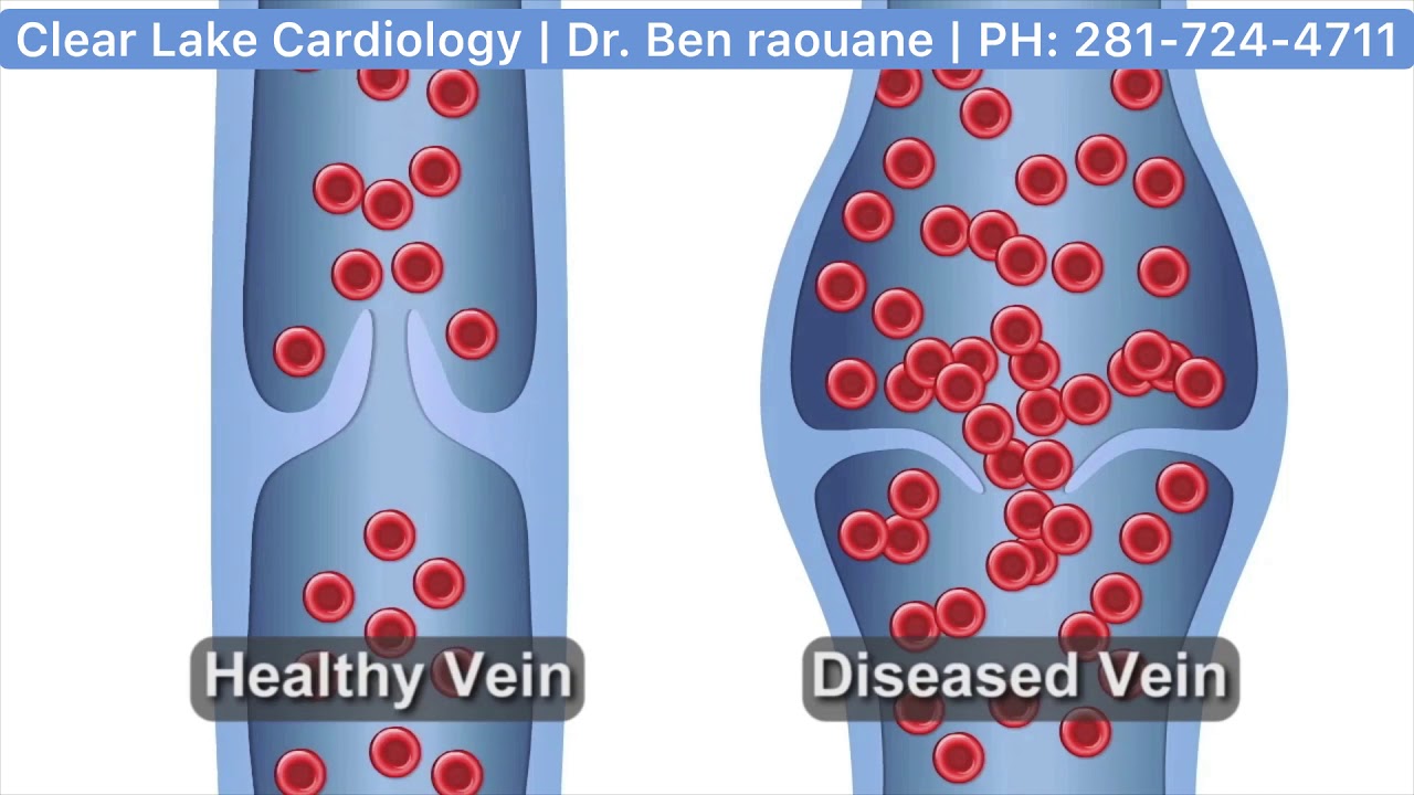 Healthy Vein vs Diseased Vein + Clear Lake Cardiology YouTube