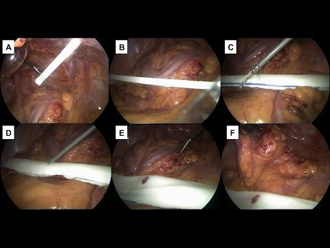 Use Of The Endoractor®  In Laparoscopic Colorectal Surgery