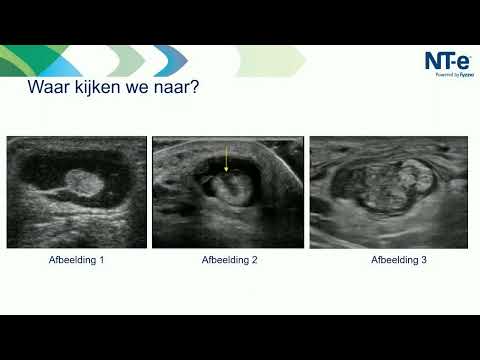 Video: Halos toegenomen - is het een pathologie?