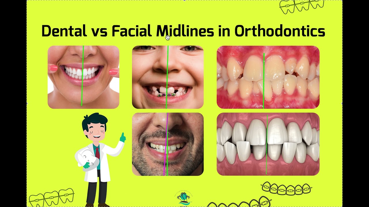Dental vs Facial Midlines in Orthodontics YouTube