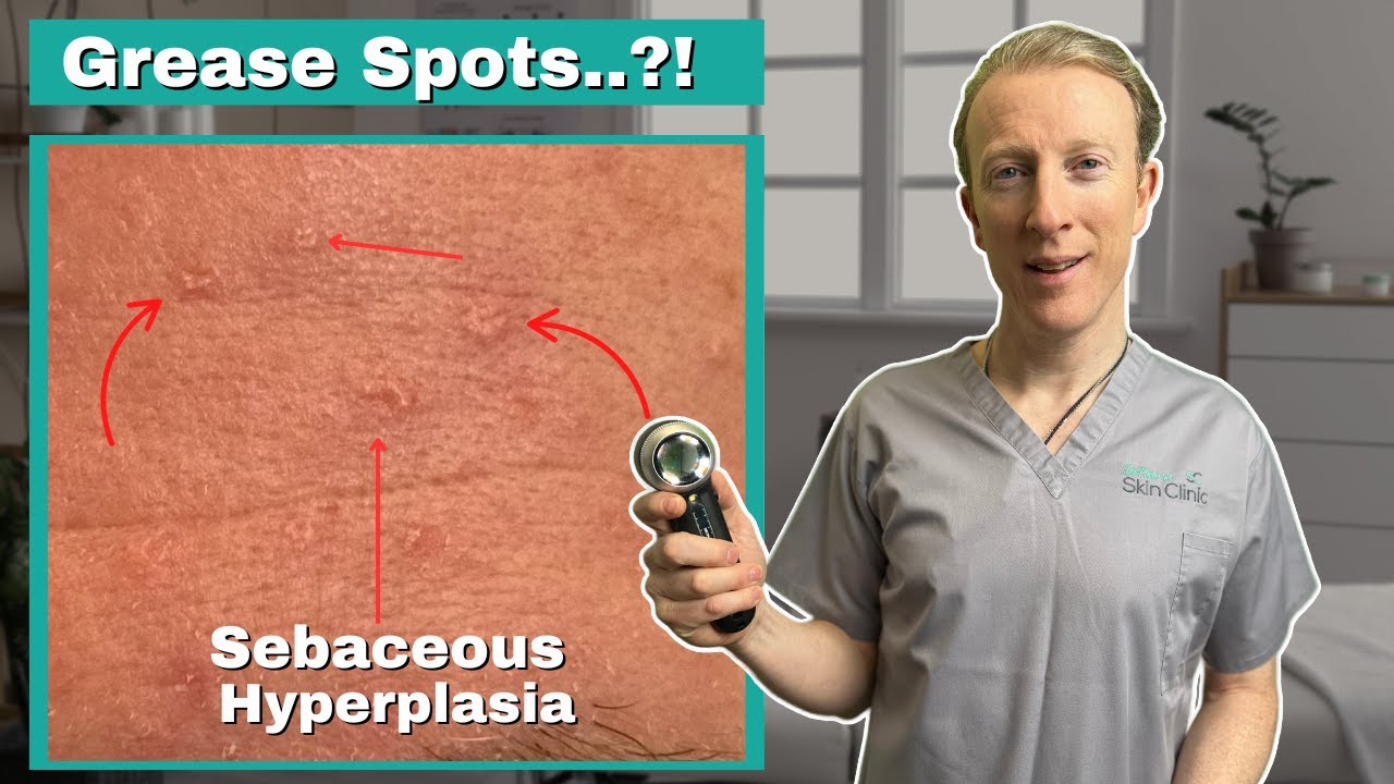 how-to-get-rid-of-sebaceous-hyperplasia-complete-guide-to-sebaceous