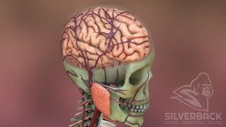 Brain Aneurysm Overview Animation