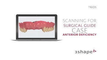3Shape TRIOS Scanning for surgical guide - Anterior deficiency case