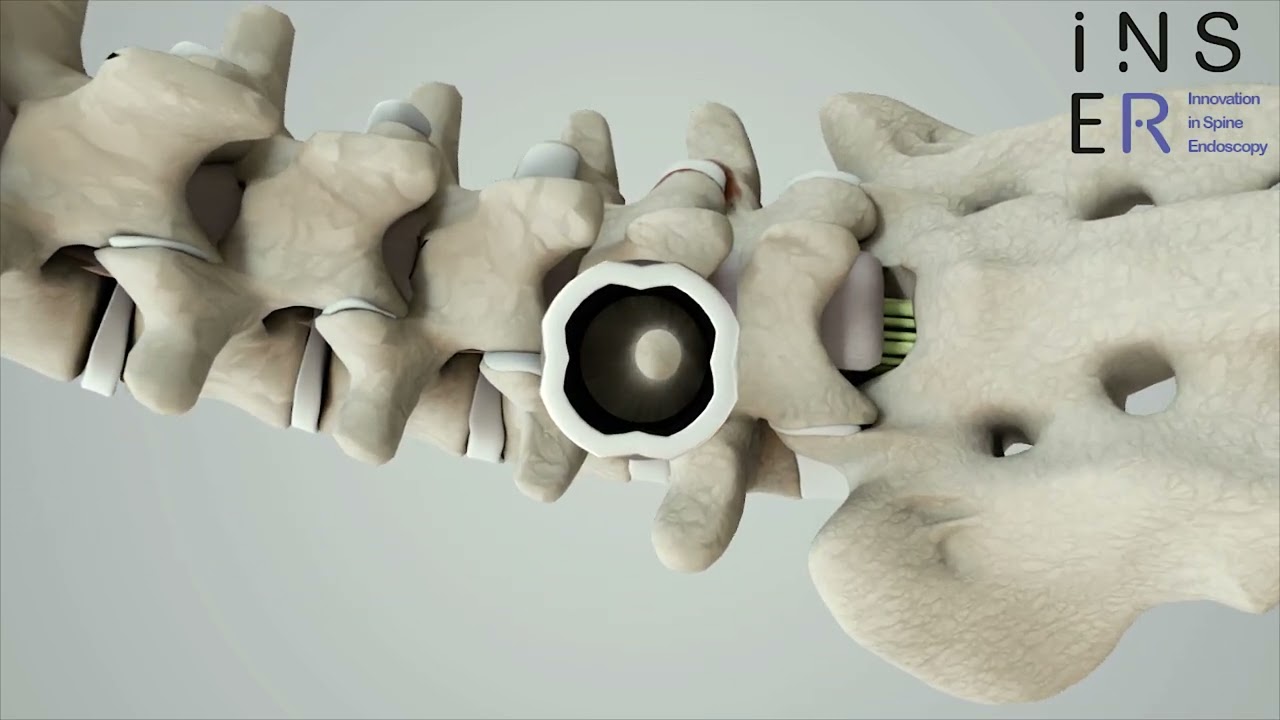 Canal lombaire étroit endoscopie