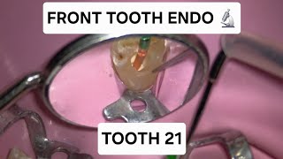 Microscopic Root Canal POV: Complete Front Tooth Procedure 🦷